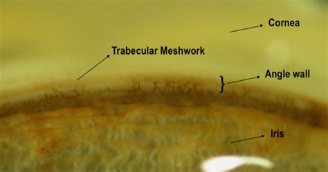 Gonioscopy Anatomy