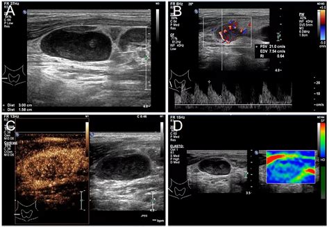 Frontiers | Case Report: Primary Mediastinal Large B-Cell Lymphoma ...