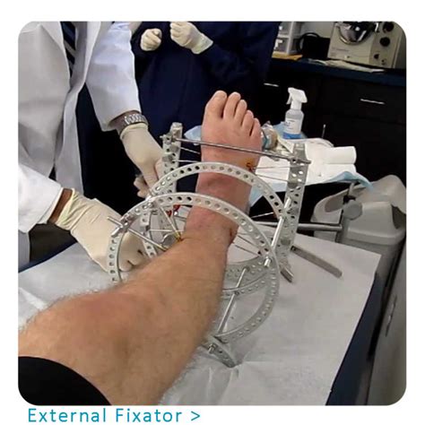 External Fixator - Orthopedic Implants Manufacturer & Suppliers ...