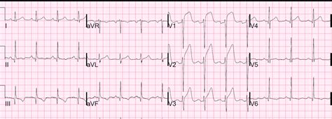 Dr. Smith's ECG Blog: Anterior ST elevation: Anterior STEMI? A ...