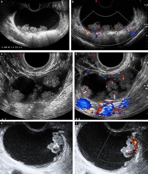 Ovarian Cyst And Cancer Ultrasound