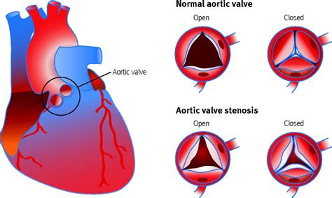 Aortic stenosis: diagnosis and management | The BMJ