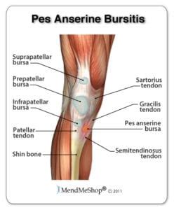 Pes Anserine Bursitis - Mississauga Chiropractor and Physiotherapy ...