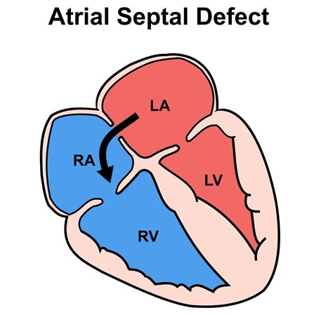 Atrial Septal Defect Anatomy