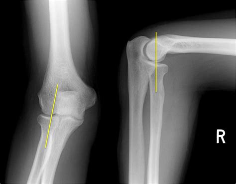 Elbow X Ray Anatomy - Anatomical Charts & Posters