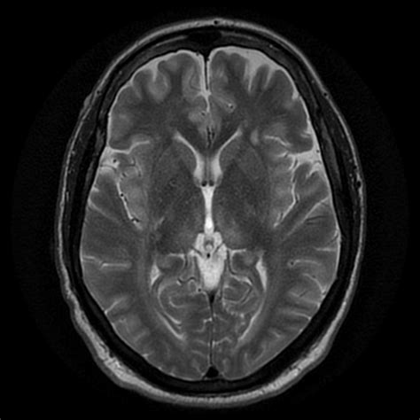 Hepatic encephalopathy MRI - wikidoc