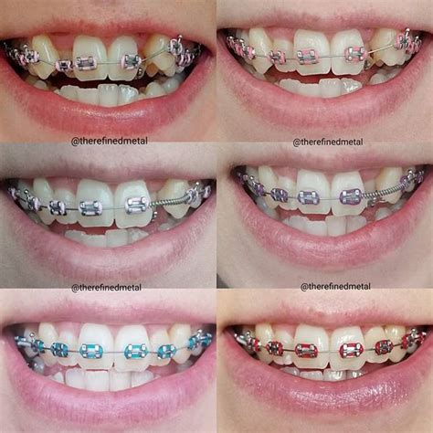 What Color Braces Should I Get? | Braces Explained