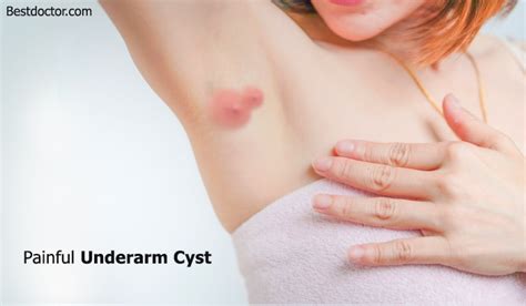 Painful Underarm Cyst- Symptoms, Causes, And Home Remedies