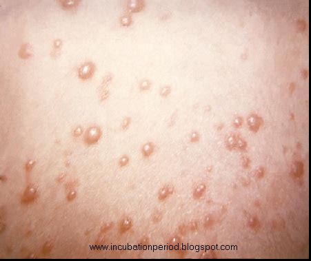 Child Rash Treatment: Enterovirus Rash Pictures