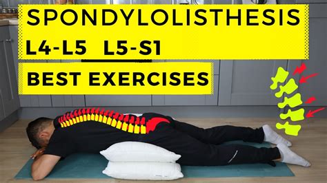 Spondylolysis and Spondylolisthesis rehabilitation exercises - Dublin ...