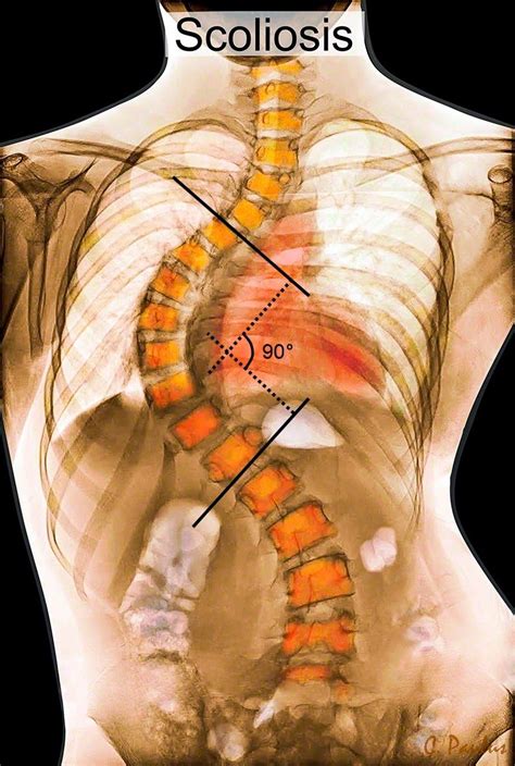 Best article on Scoliosis Surgery - Are Some Patients Predisposed To ...