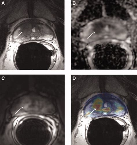 State of the art in oncologic imaging of Prostate. | Leaders in ...