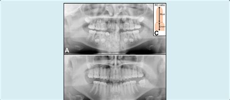 Panoramic radiographs from case 1 taken during mixed dentition (8 ...