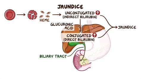 Unconjugated hyperbilirubinemia causes, symptoms, diagnosis and ...