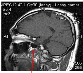 b: Saggital MRI brain showing empty sella | Download Scientific Diagram