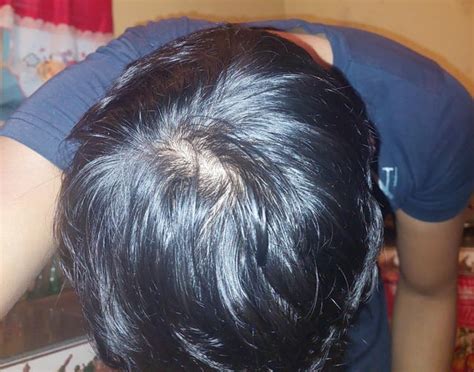 finasteride 10 month results before and after, 1mg per day, 22M : r ...