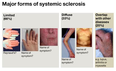 Scleroderma: Types, Symptoms & Treatment » How To Relief