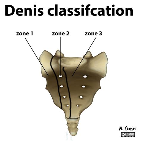 Sacral Fractures - Presentation and Treatment | Bone and Spine