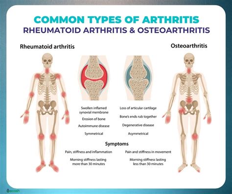 OSTEOARTHRITIS (OA) – Symptoms, Causes, Risk Groups, Prevention and ...