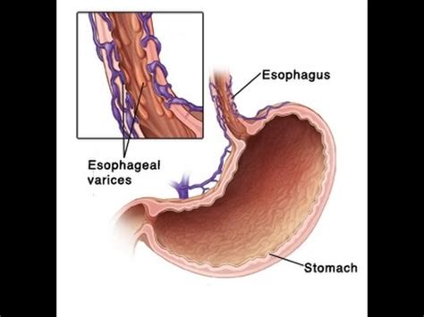 Esophageal Varices Grading