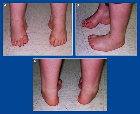 Foot and Ankle Deformities | Musculoskeletal Key