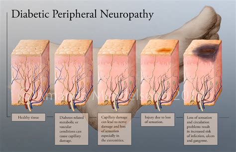 Help for Diabetic Neuropathy - LewRockwell