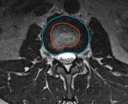 Nucleus pulposus | Radiology Reference Article | Radiopaedia.org