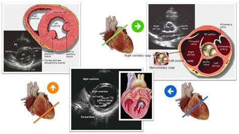 Focused Cardiac Ultrasound for the Nephrologist: The Parasternal Short ...