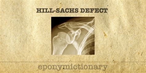 Hill-Sachs defect • LITFL • Medical Eponym Library