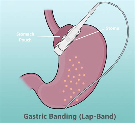 Lap-Band Failure, Removals - Costs, Symptoms, Rates