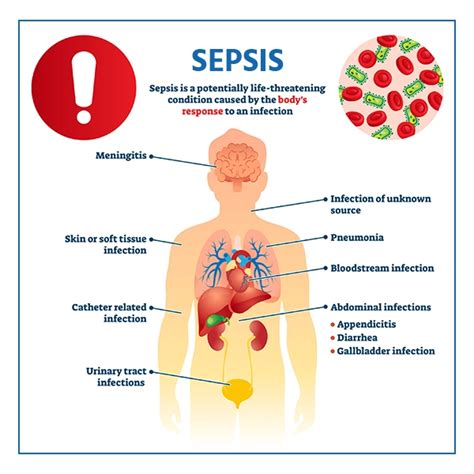 Sepsis Symptoms, Causes, Diagnosis & Treatment