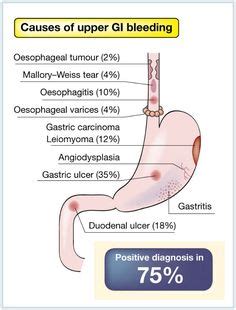 Upper GI bleeding