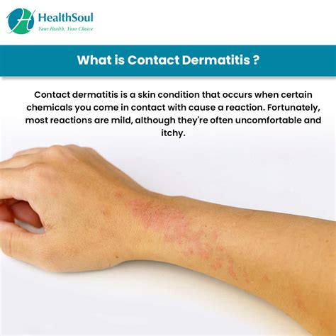 Eczema And Atopic Dermatitis Rashes Causes Symptoms