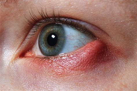 Eyelid Lumps and Cysts (Chalazion) | Consultant Ophthalmologist Nottingham