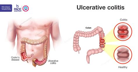 Ulcerative colitis: causes, symptoms, complications and treatment