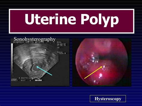 Infertility Hysteroscopy