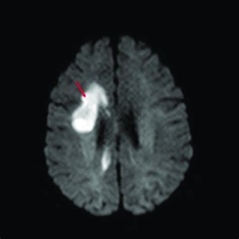 Diffusion ADC map showing intense restricted diffusion (black) in the ...