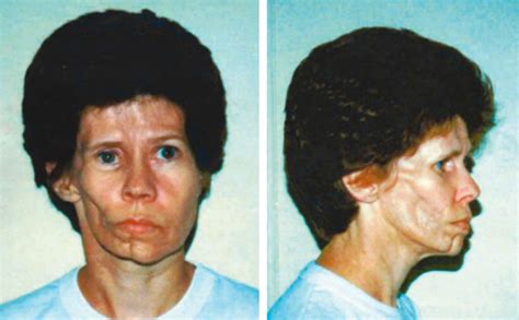 Parry Romberg syndrome causes, symptoms, diagnosis & treatment