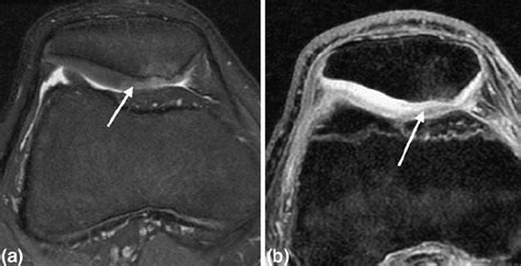 What is Chondromalacia Patellae? - El Paso, TX Doctor Of Chiropractic