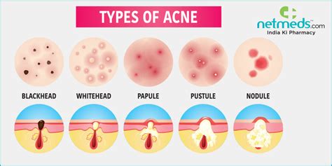 Difference Between Cyst and Pimple - Differences Finder