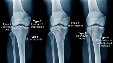 Tibial Plateau Fracture Brace | Best Brace Tibial Plateau Fracture