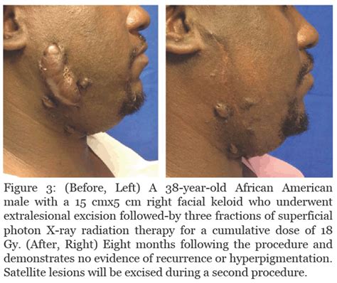 Keloid Treatment