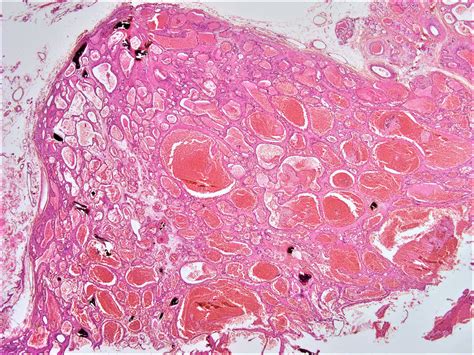 Skin Hemangioma Histology