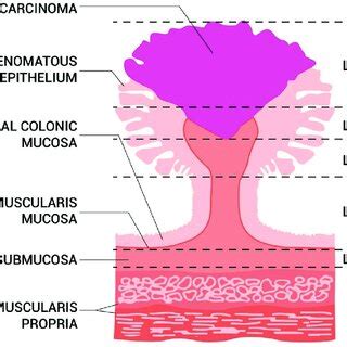 Haggitt classification system of pedunculated polyp (adapted from ...