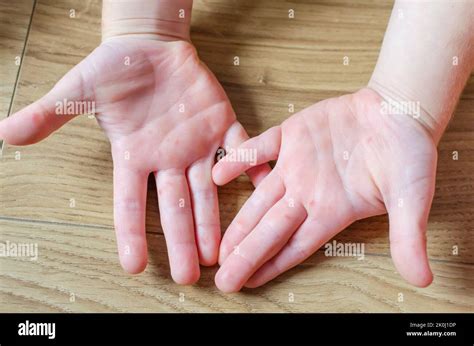 Enterovirus Hand Rash on the body of a child. Cocksackie virus rash ...