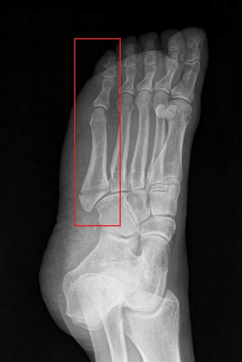 5th Metatarsal Bone Pain