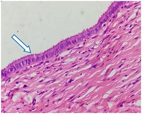 An Unusual Presentation of a Huge Nabothian Cyst of Cervix With ...