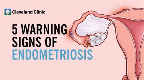 Everything You Need to Know About Endometriosis: Symptoms, Causes ...