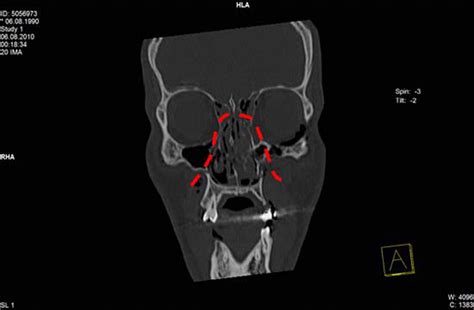 Heading the ball: a case of a Le Fort II fracture in a football match ...