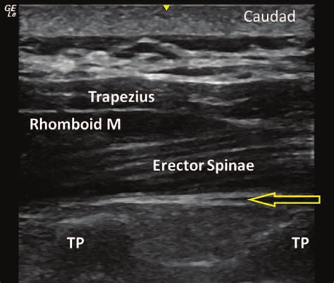 Erector Spinae Block Ultrasound